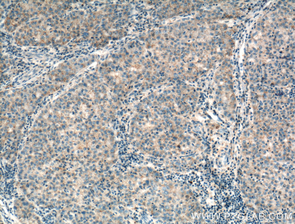 IHC staining of human liver cancer using 15485-1-AP