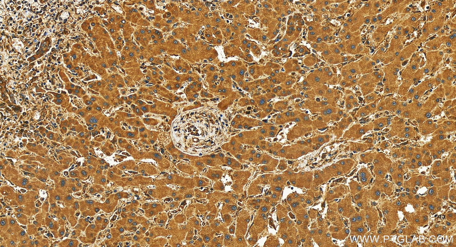 IHC staining of human intrahepatic cholangiocarcinoma using 82960-5-RR (same clone as 82960-5-PBS)