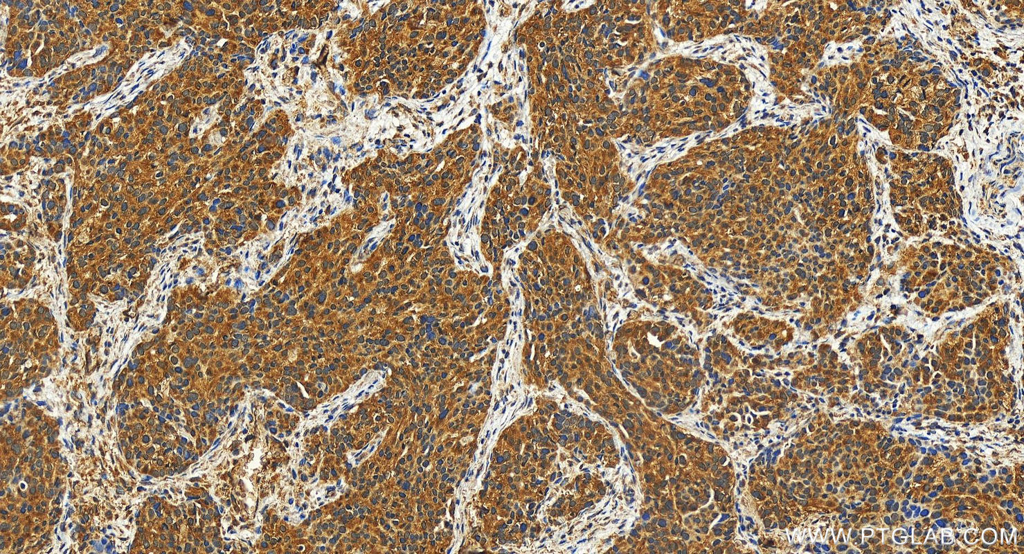 IHC staining of human ovary cancer using 27435-1-AP