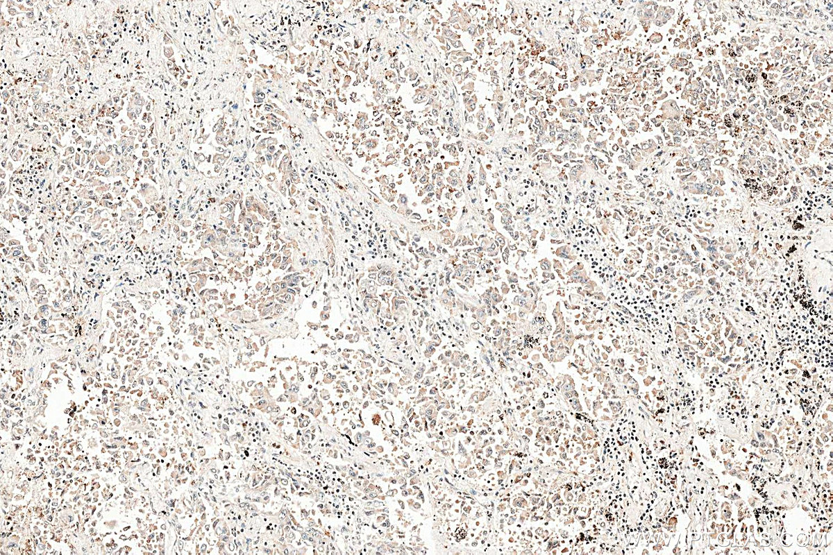 IHC staining of human lung cancer using 13051-1-AP