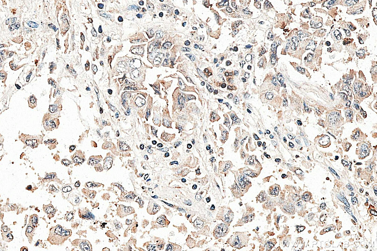 IHC staining of human lung cancer using 13051-1-AP