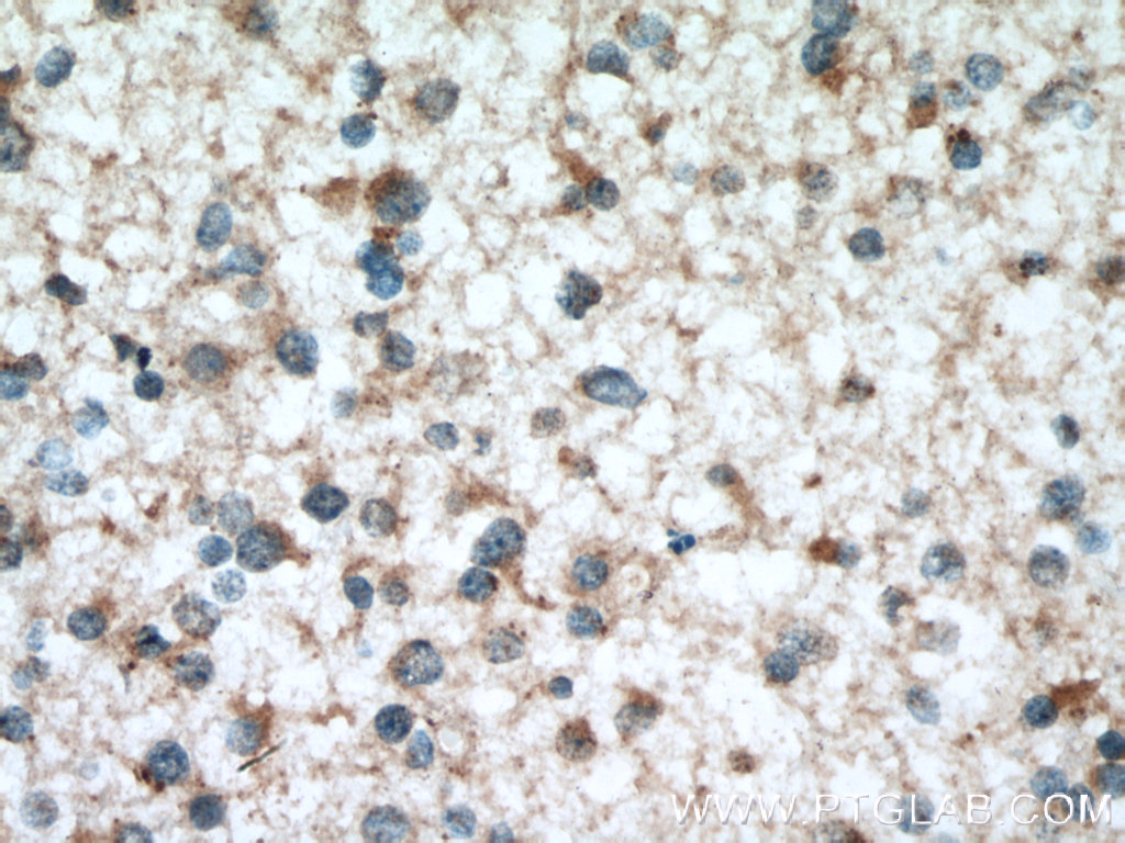 IHC staining of human gliomas using 12234-1-AP