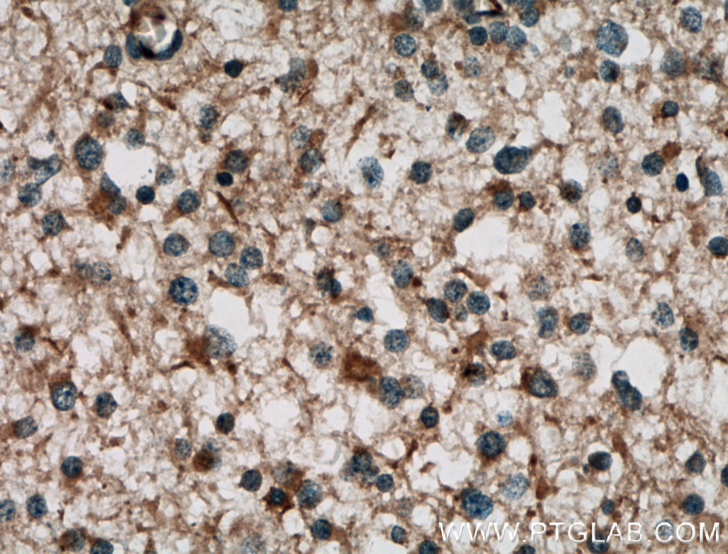 IHC staining of human gliomas using 13355-1-AP