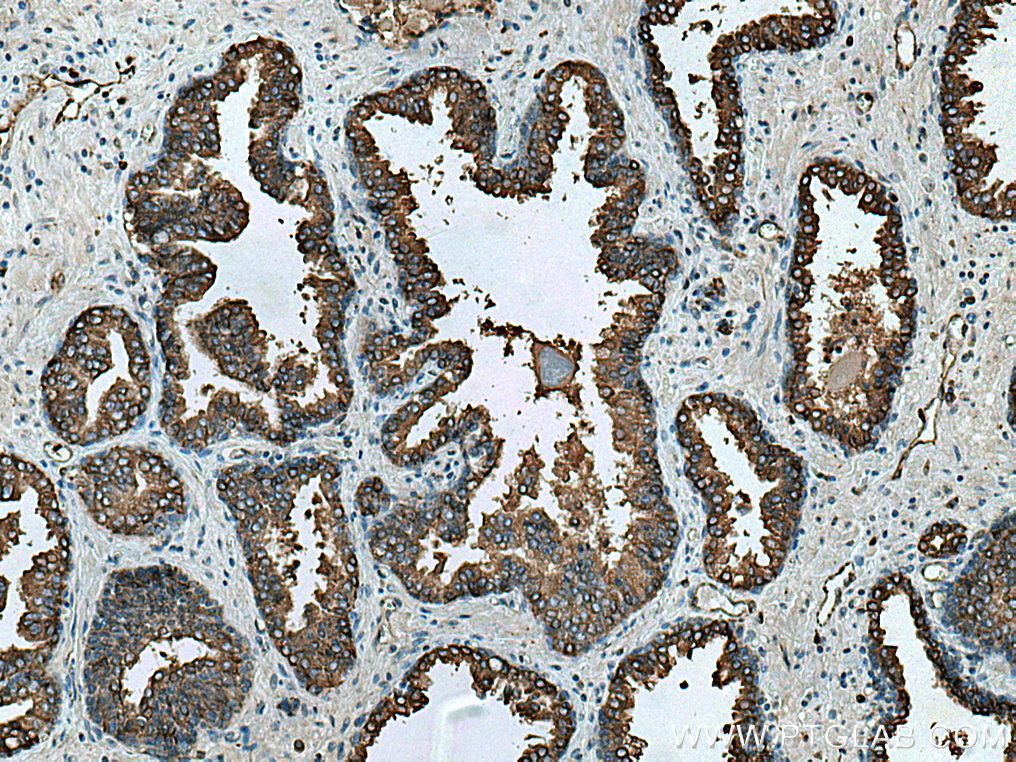 IHC staining of human prostate cancer using 12320-1-AP