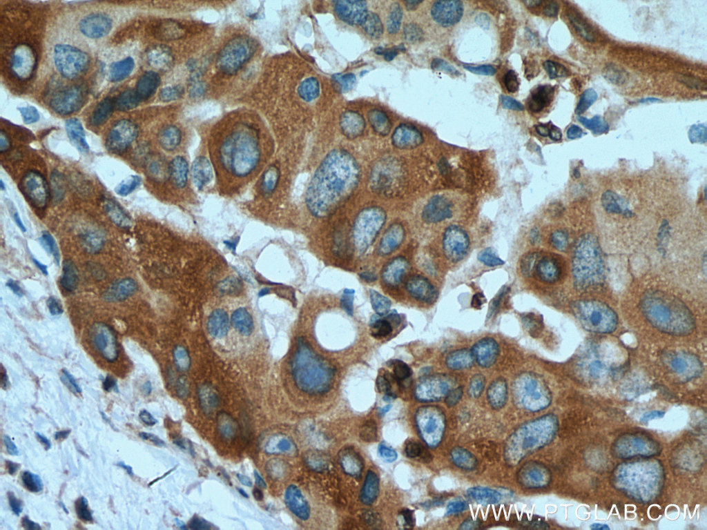 IHC staining of human colon cancer using 67118-1-Ig