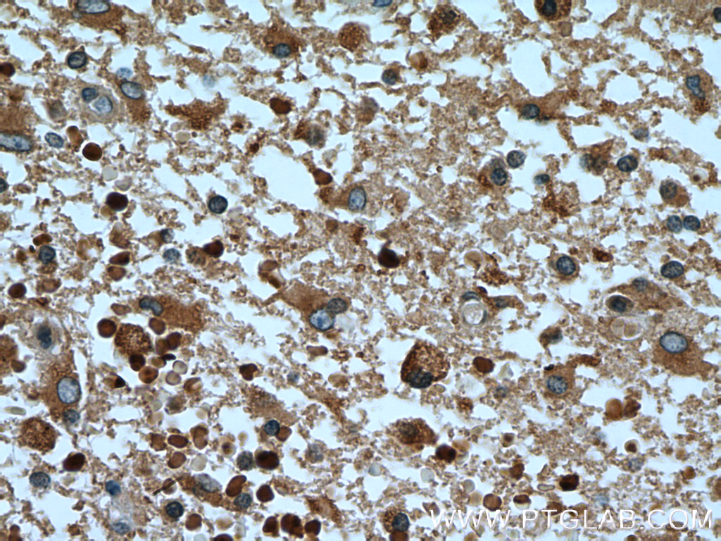 IHC staining of human gliomas using 11947-1-AP