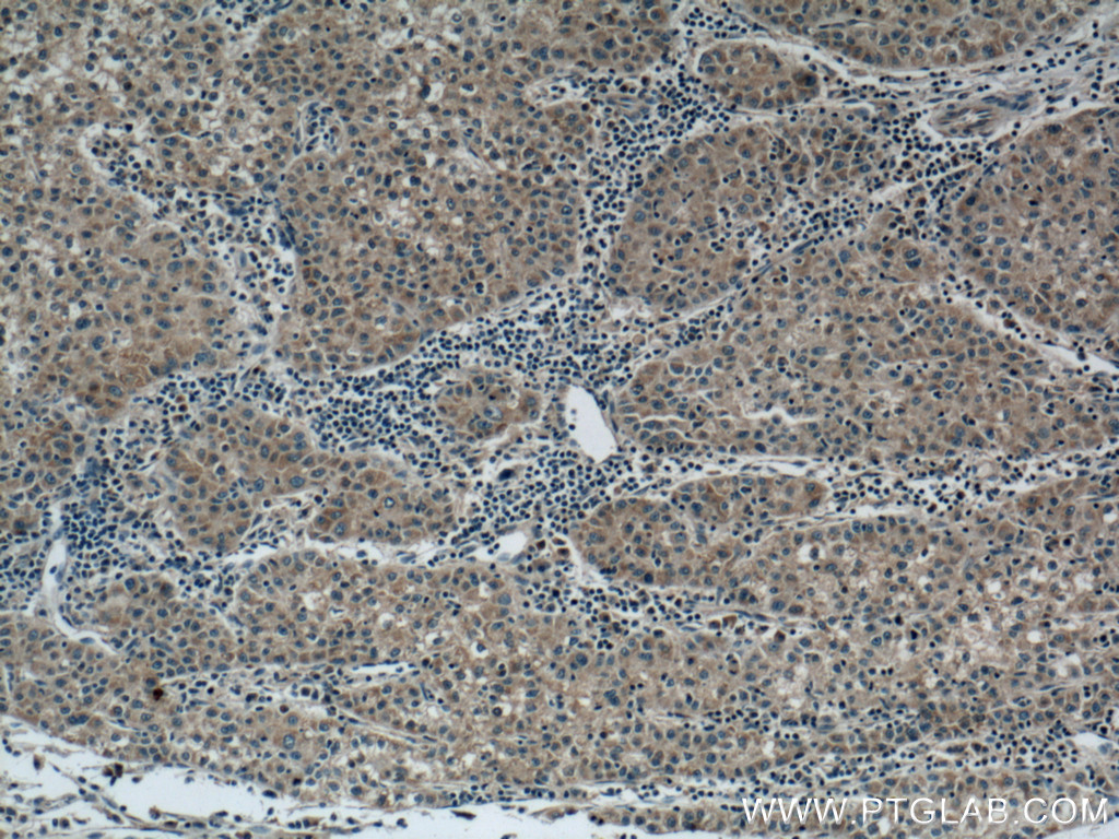 IHC staining of human liver cancer using 66339-1-Ig (same clone as 66339-1-PBS)