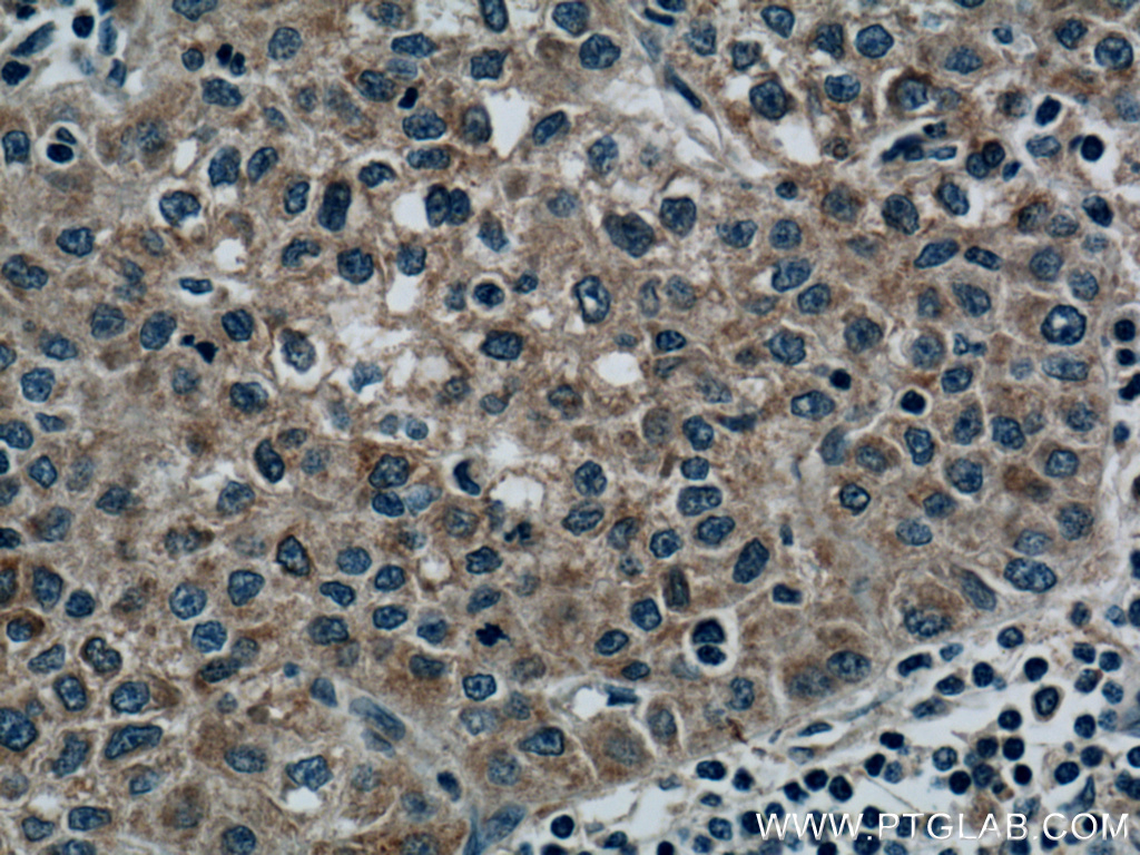 IHC staining of human liver cancer using 66339-1-Ig (same clone as 66339-1-PBS)