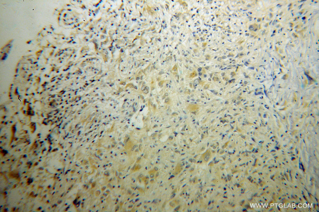 IHC staining of human gliomas using 10340-1-AP