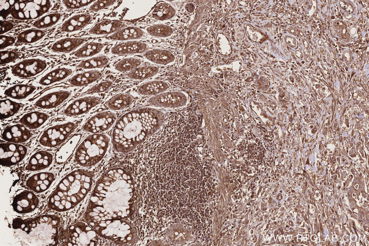 IHC staining of human rectal cancer using 11792-1-AP IHC staining of human rectal cancer using 11792-1-AP