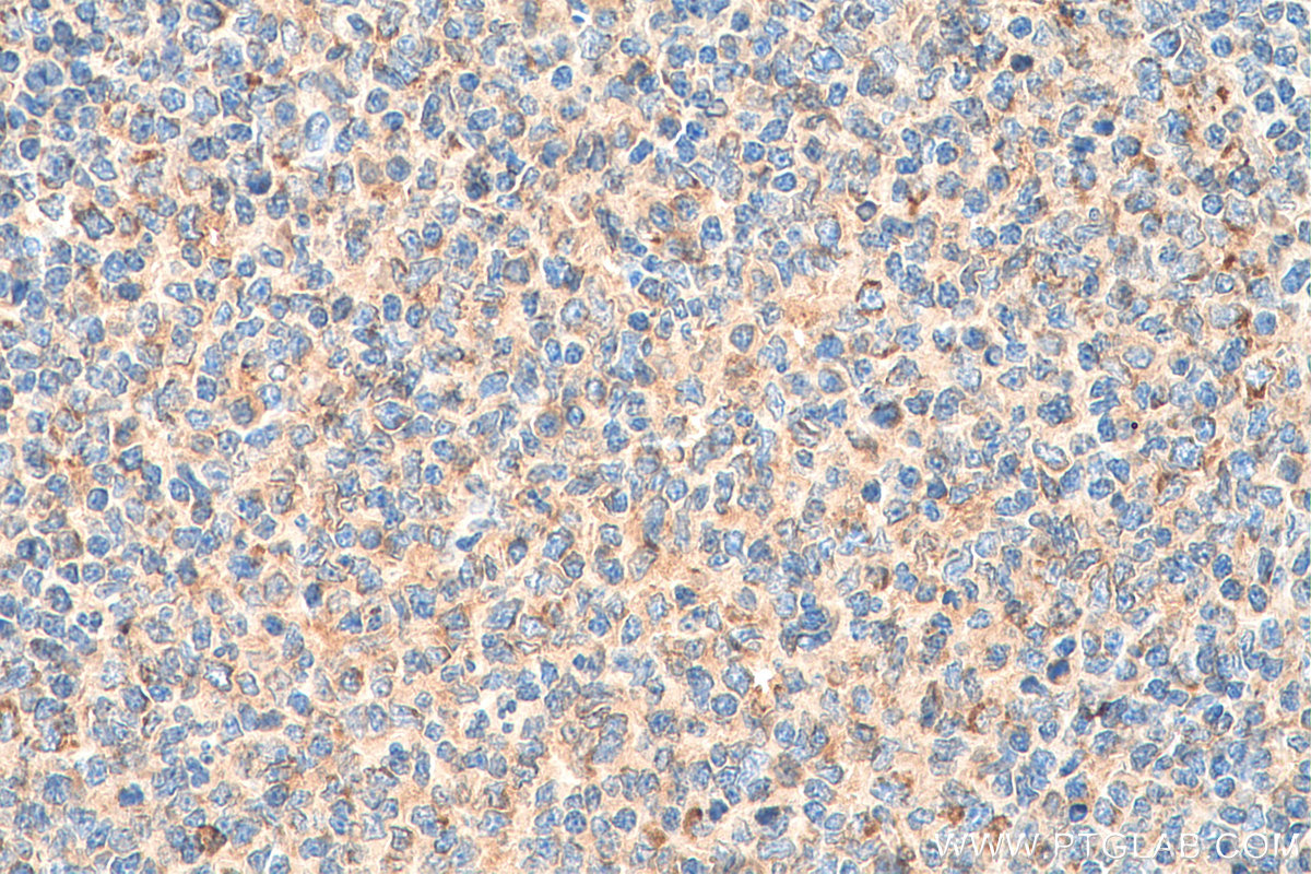 IHC staining of human tonsillitis using 11420-1-AP