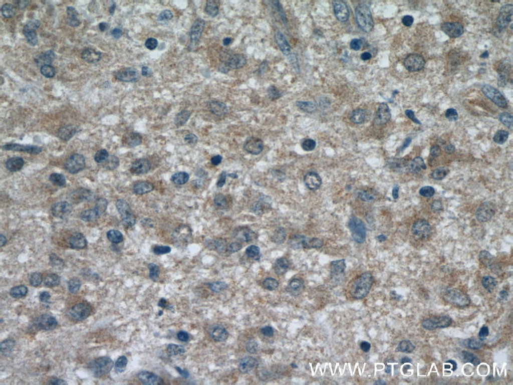 IHC staining of human gliomas using 18719-1-AP