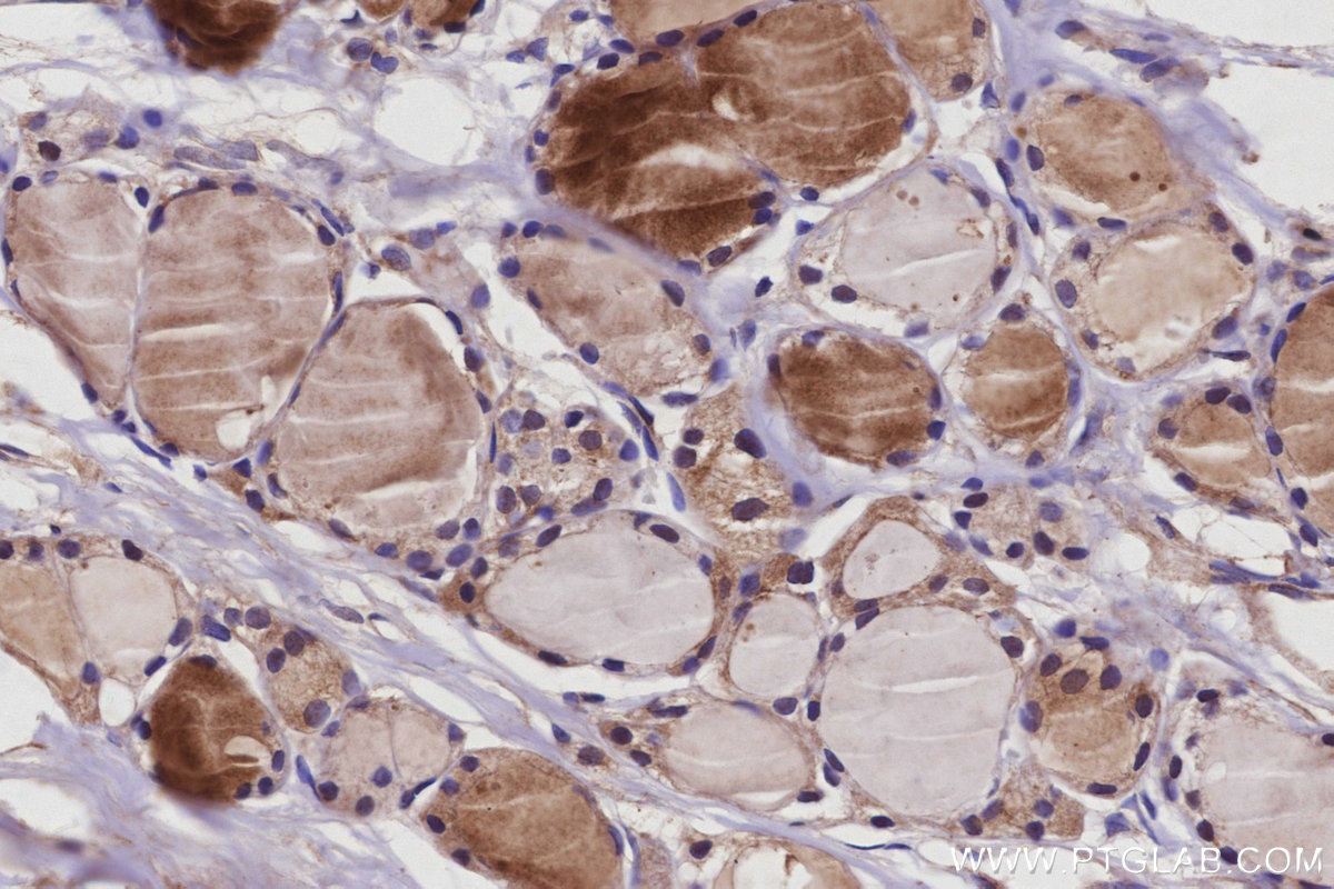 IHC staining of human thyroid cancer using 68031-1-Ig