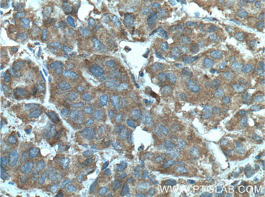 IHC staining of human prostate cancer using 60125-1-Ig