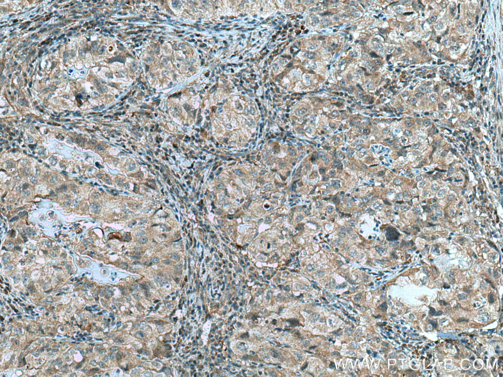 IHC staining of human lung cancer using 10213-2-AP