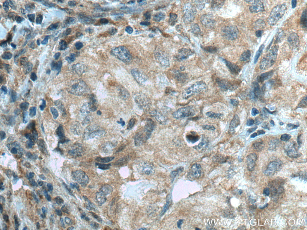 IHC staining of human lung cancer using 10213-2-AP