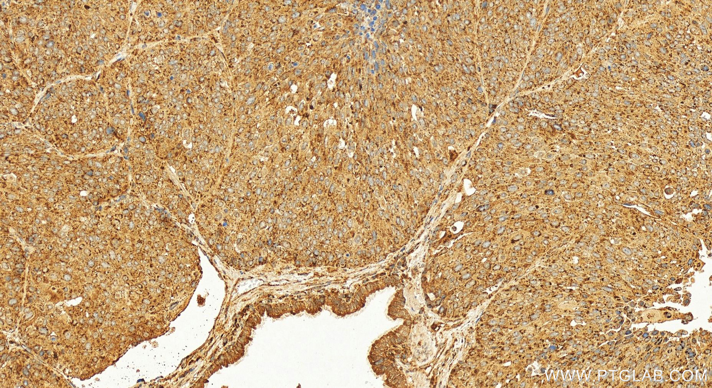 IHC staining of human lung squamous cell carcinoma using 15105-1-AP