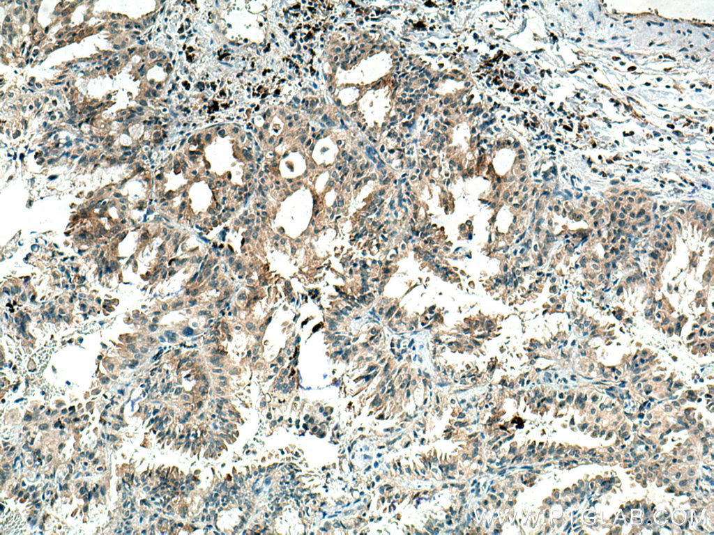 IHC staining of human lung cancer using 66622-1-Ig (same clone as 66622-1-PBS)