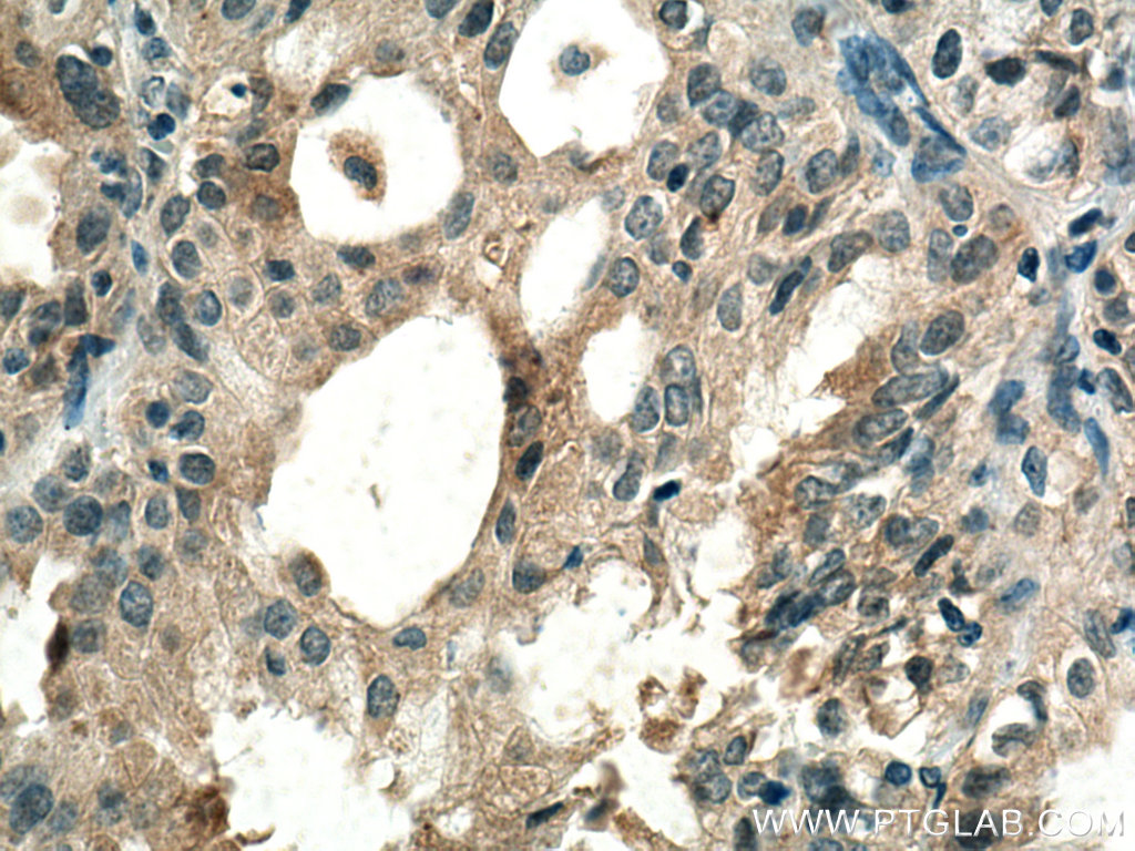 IHC staining of human lung cancer using 66622-1-Ig