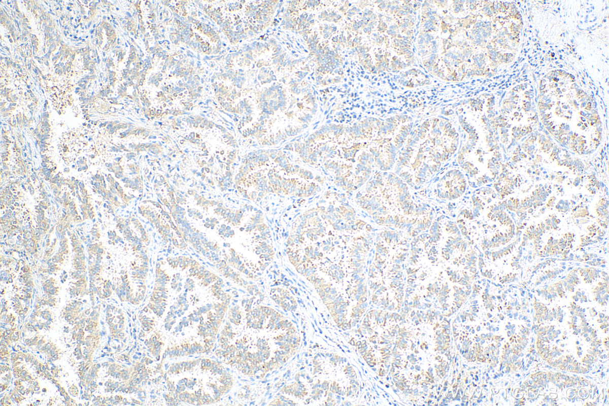 IHC staining of human lung cancer using 24072-1-AP