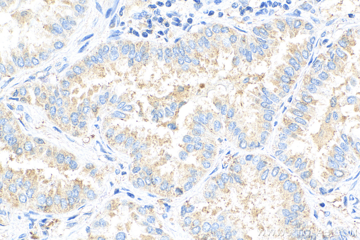 IHC staining of human lung cancer using 24072-1-AP