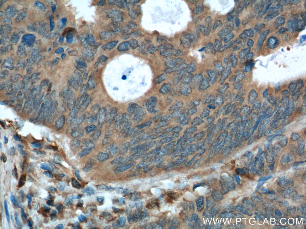 IHC staining of human colon cancer using 66122-1-Ig