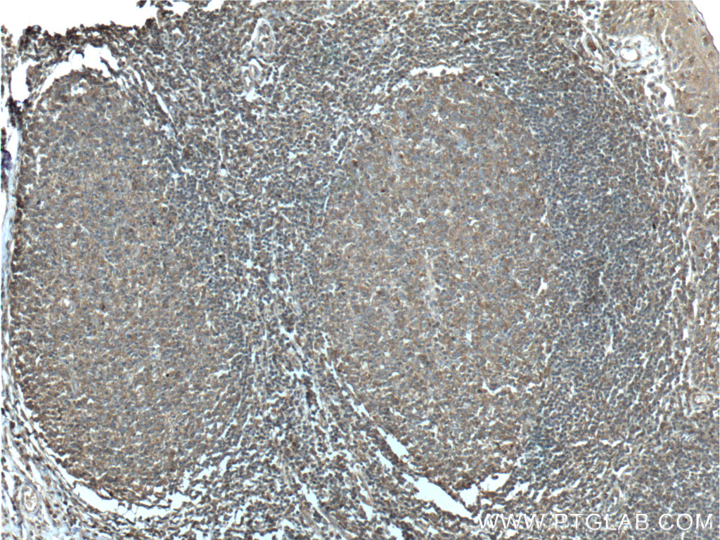 IHC staining of human tonsillitis using 10735-1-AP