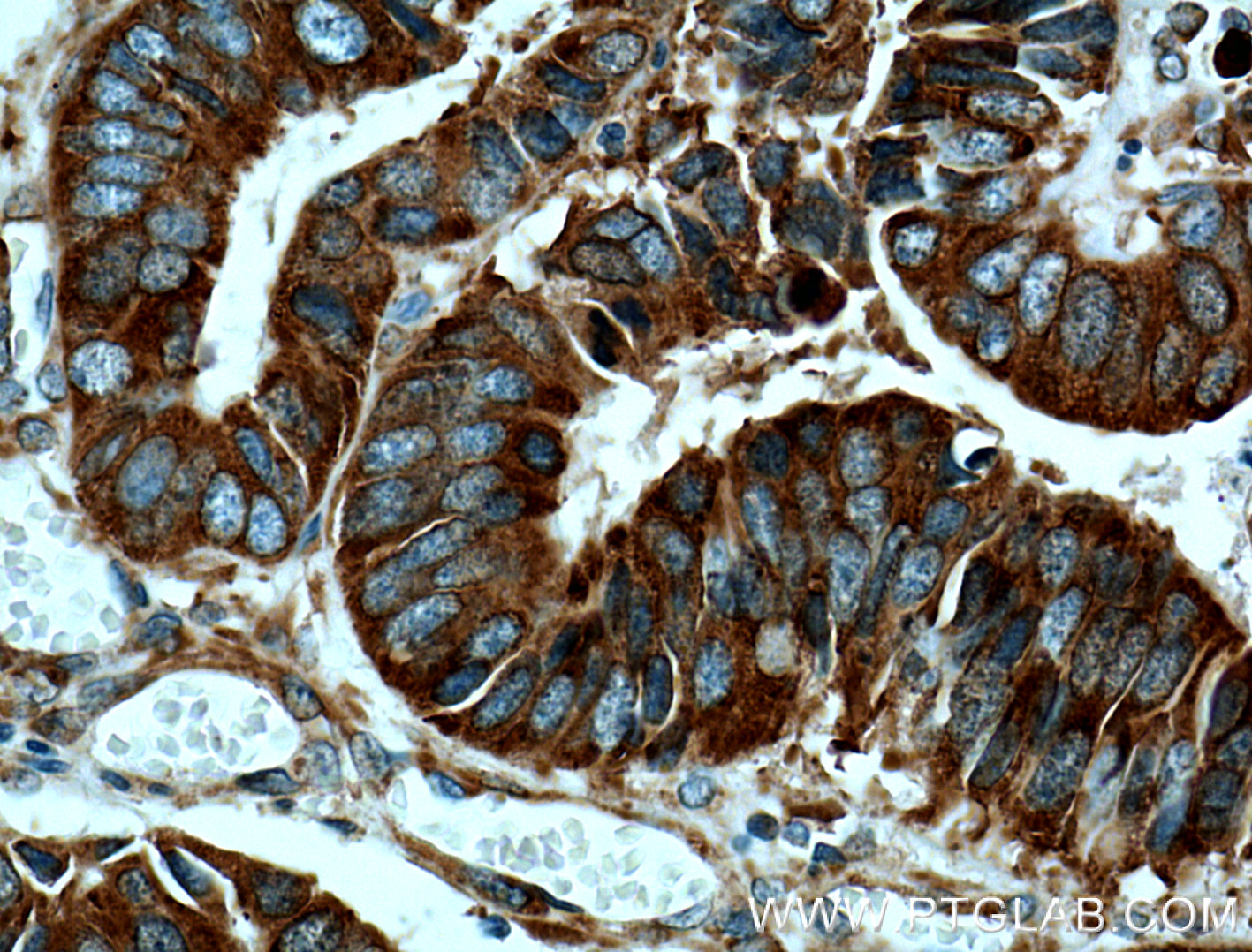 IHC staining of human colon cancer using 66056-1-Ig (same clone as 66056-1-PBS)