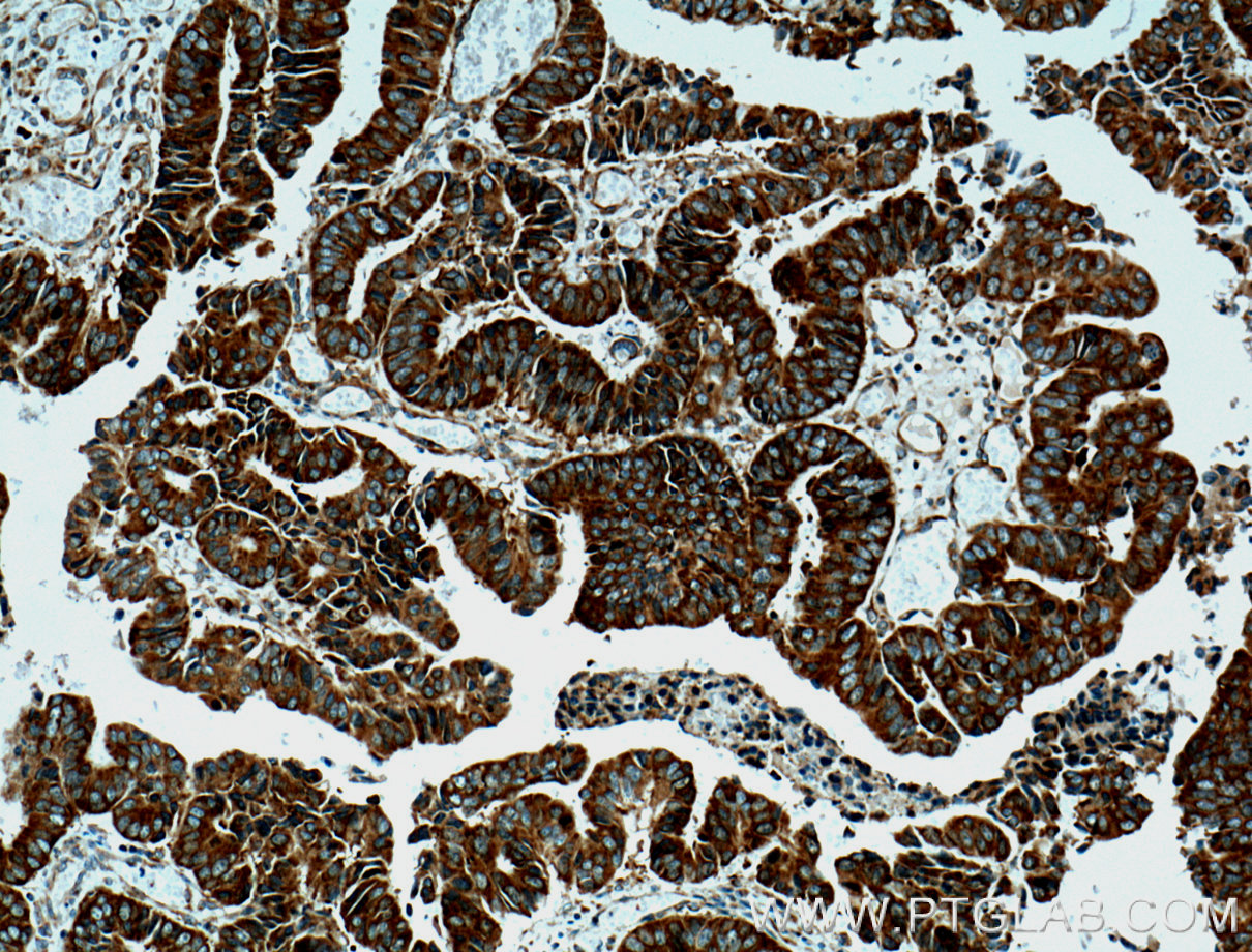 IHC staining of human colon cancer using 66056-1-Ig (same clone as 66056-1-PBS)