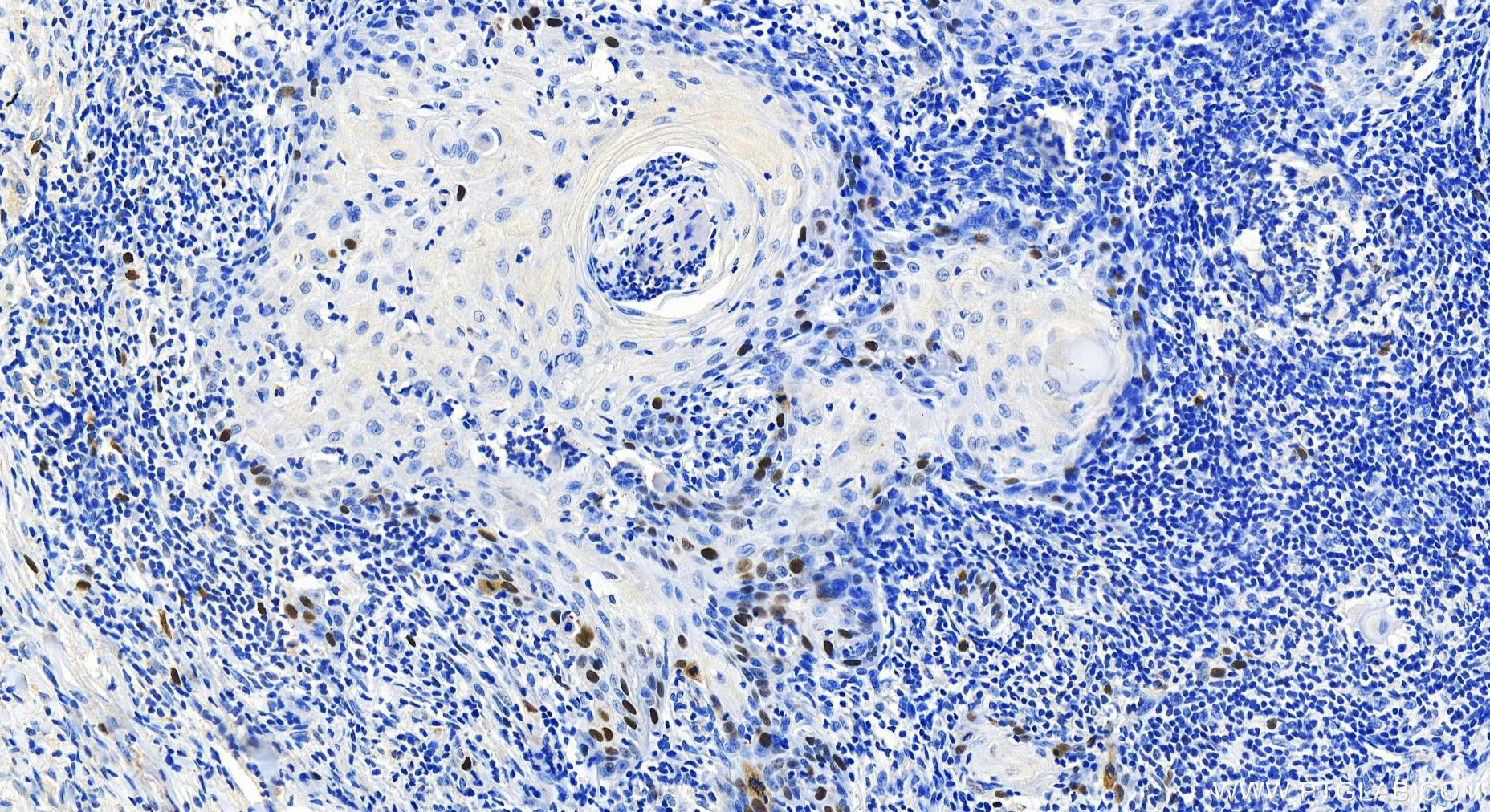 IHC staining of human skin cancer using 82788-1-RR (same clone as 82788-1-PBS)