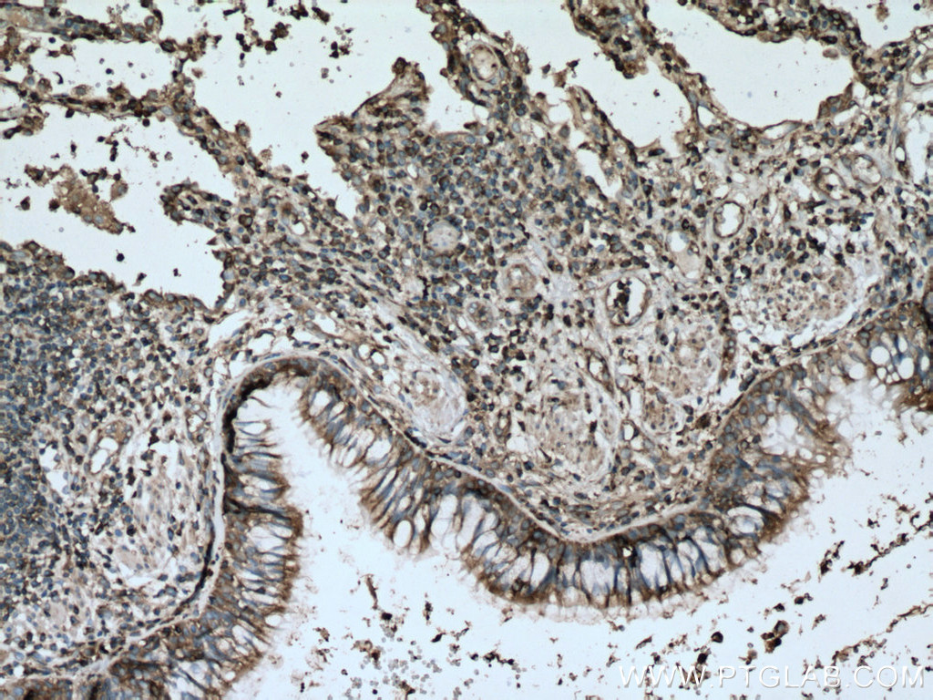 IHC staining of human lung cancer using 66940-1-Ig (same clone as 66940-1-PBS)