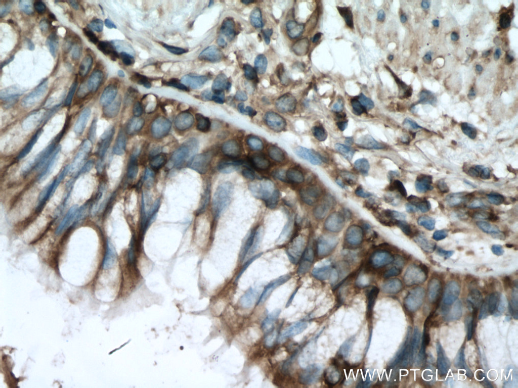 IHC staining of human lung cancer using 66940-1-Ig (same clone as 66940-1-PBS)