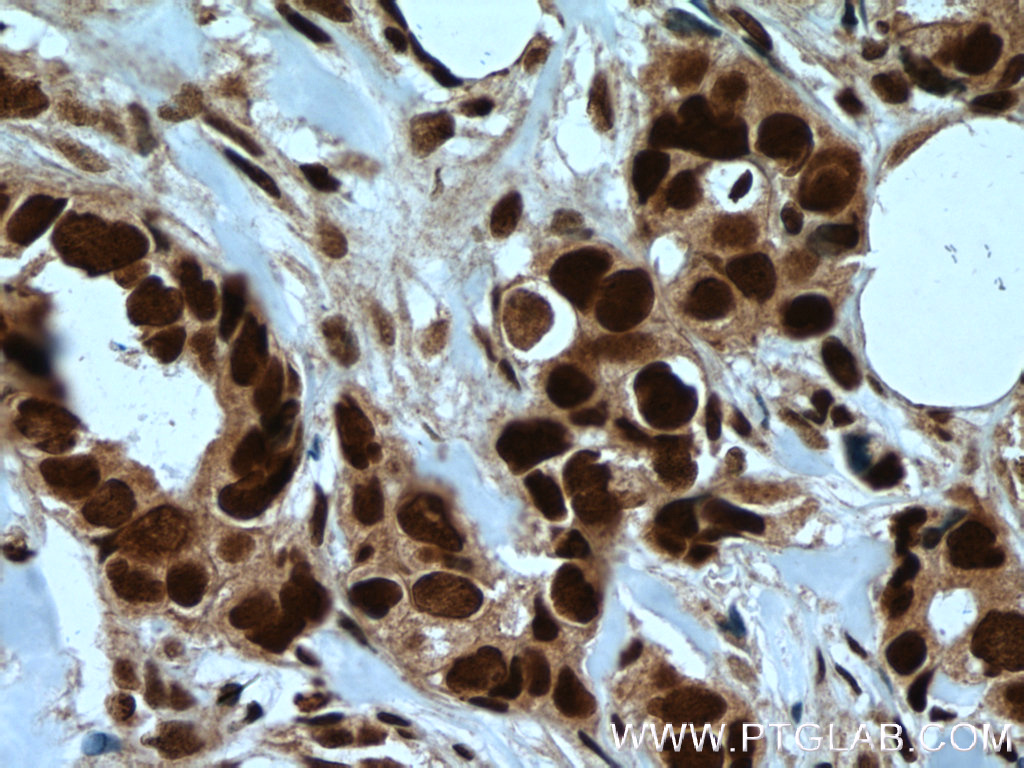 IHC staining of human breast cancer using 27071-1-AP