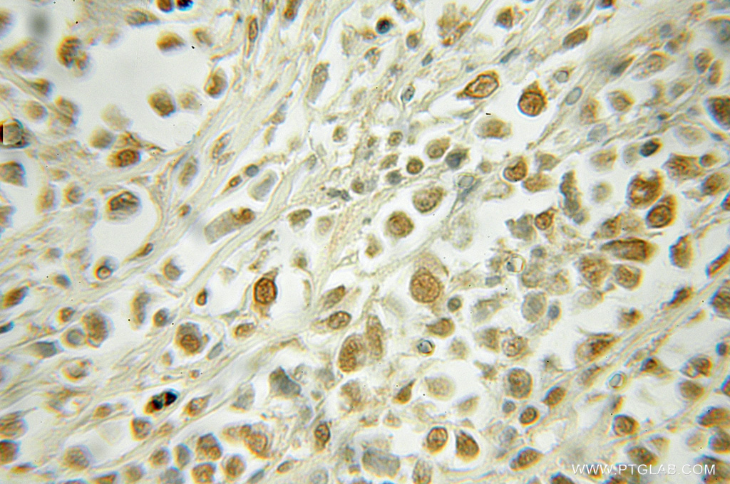 IHC staining of human lymphoma using 51033-1-AP (same clone as 51033-1-PBS)