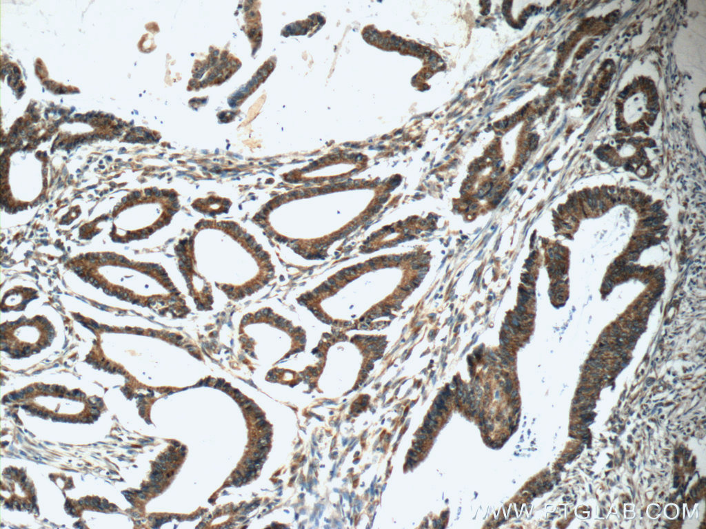 IHC staining of human colon cancer using 12388-1-AP
