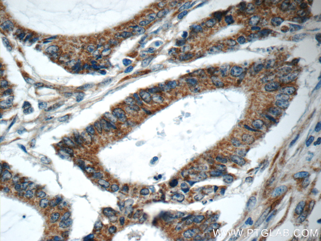 IHC staining of human colon cancer using 12388-1-AP