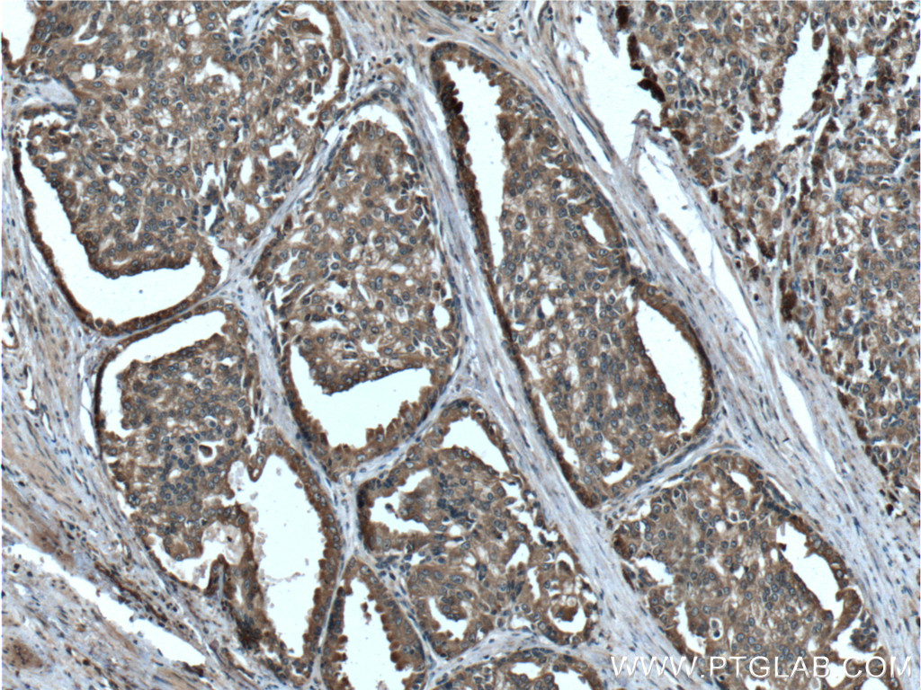 IHC staining of human prostate cancer using 26863-1-AP