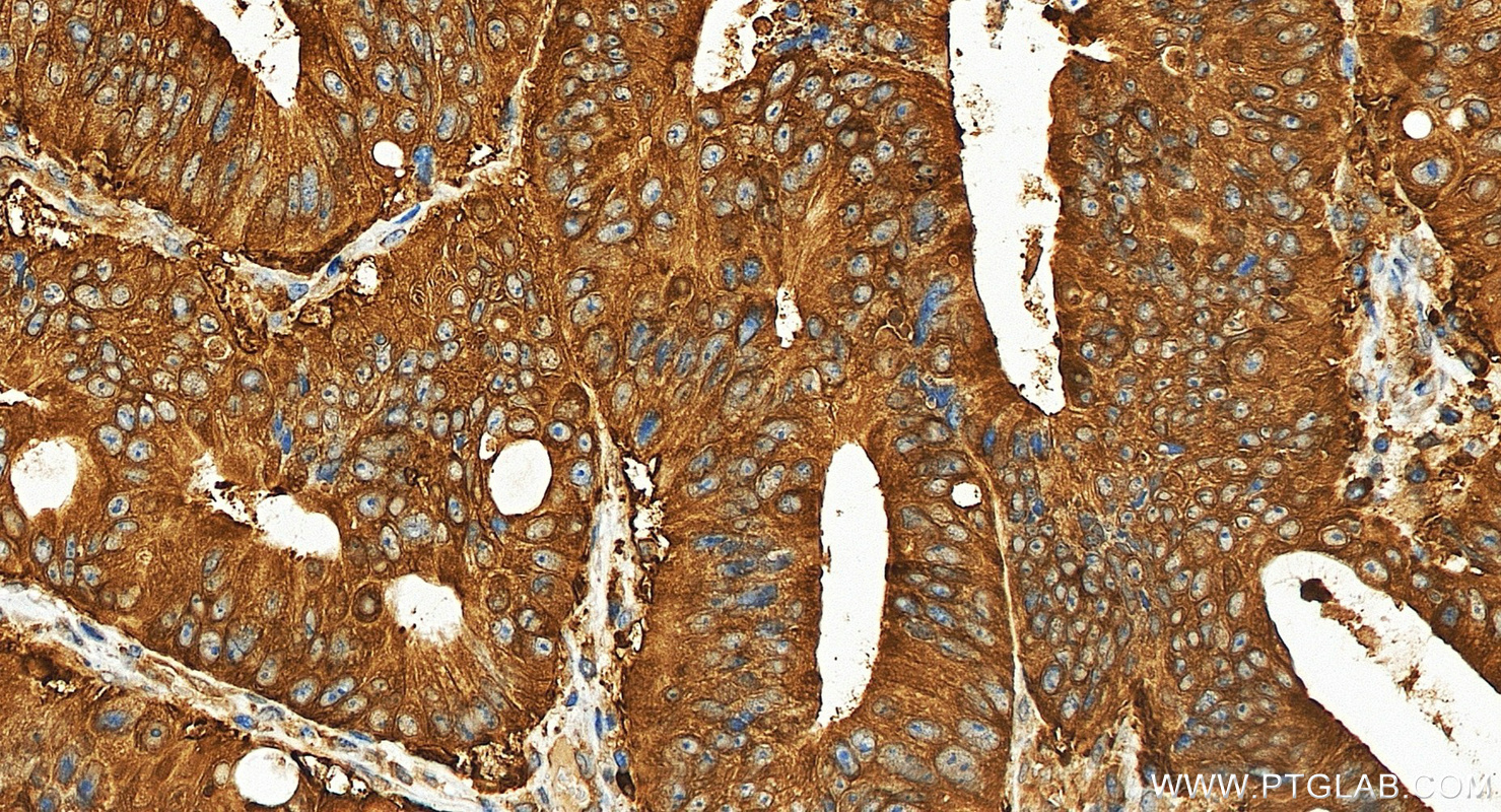 IHC staining of human colon cancer using 84994-4-RR IHC staining of human colon cancer using 84994-4-RR