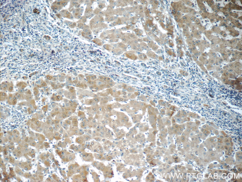 IHC staining of human hepatocirrhosis using 23926-1-AP