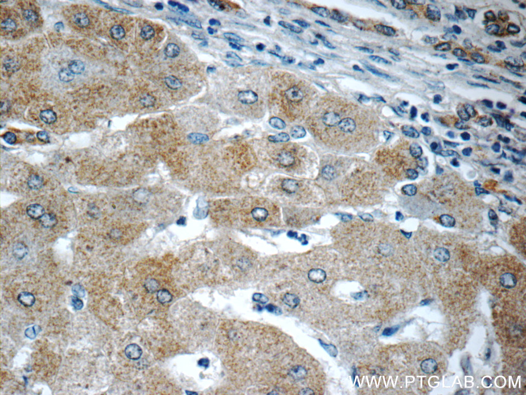 IHC staining of human hepatocirrhosis using 23926-1-AP