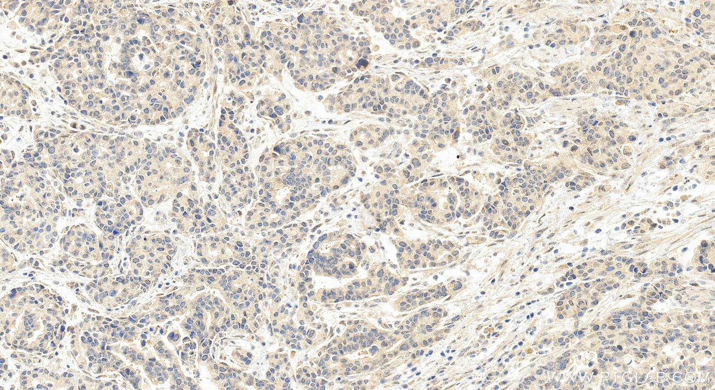 IHC staining of human stomach cancer using 17084-1-AP