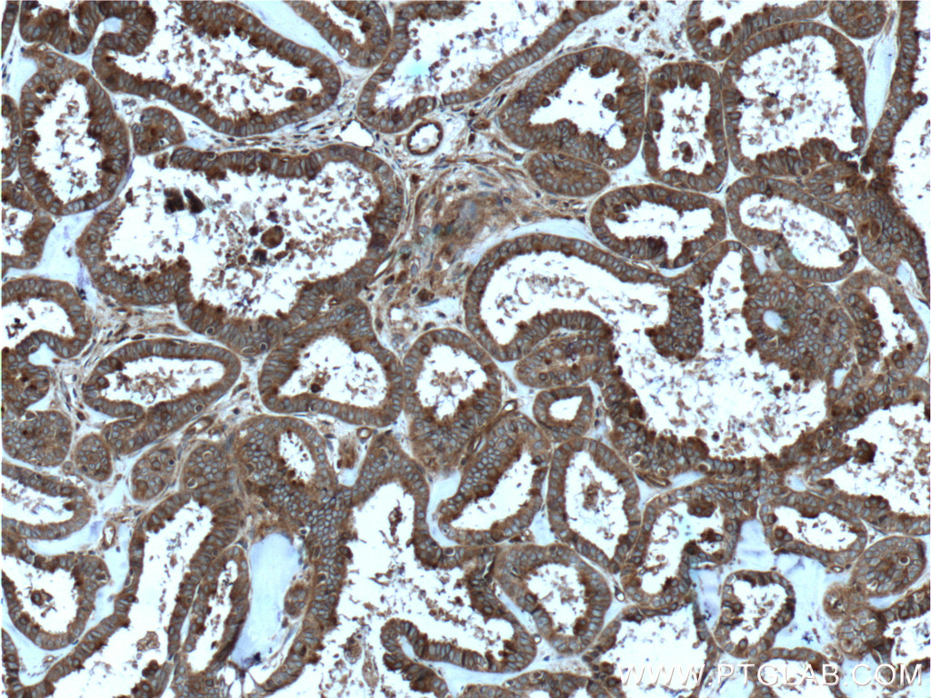 IHC staining of human ovary tumor using 12340-1-AP