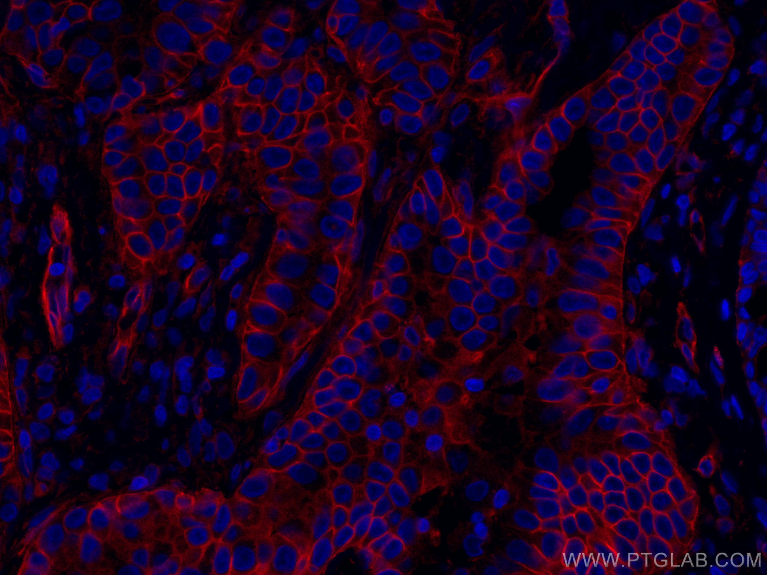 IF Staining of human lung cancer using CL594-67094