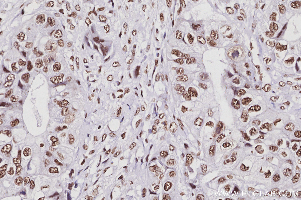 IHC staining of human pancreas cancer using 17896-1-AP