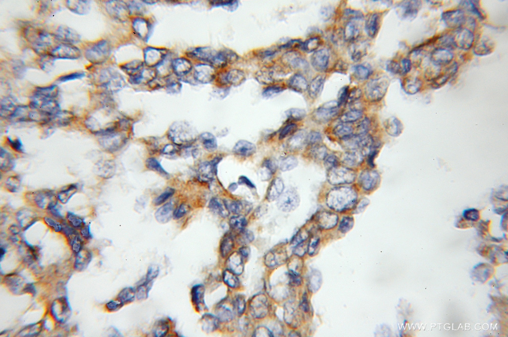 IHC staining of human breast cancer using 11861-1-AP