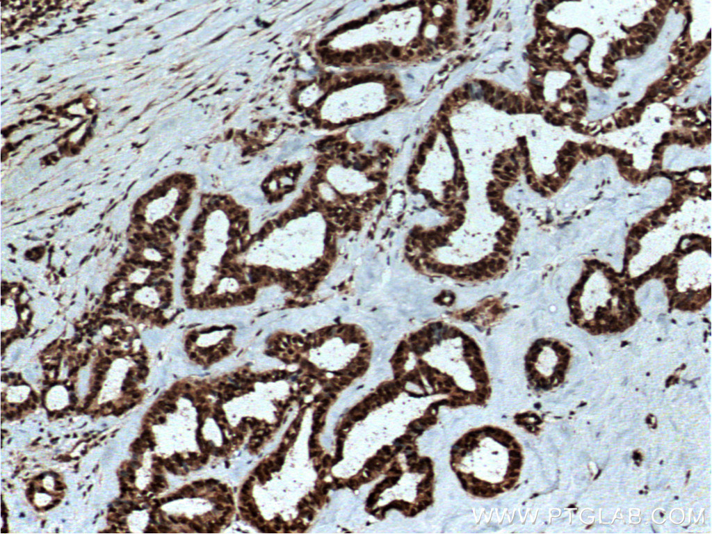 IHC staining of human breast cancer using 10469-1-AP