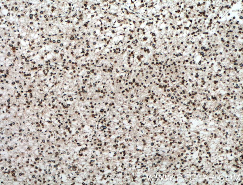 IHC staining of human gliomas using 11102-1-AP
