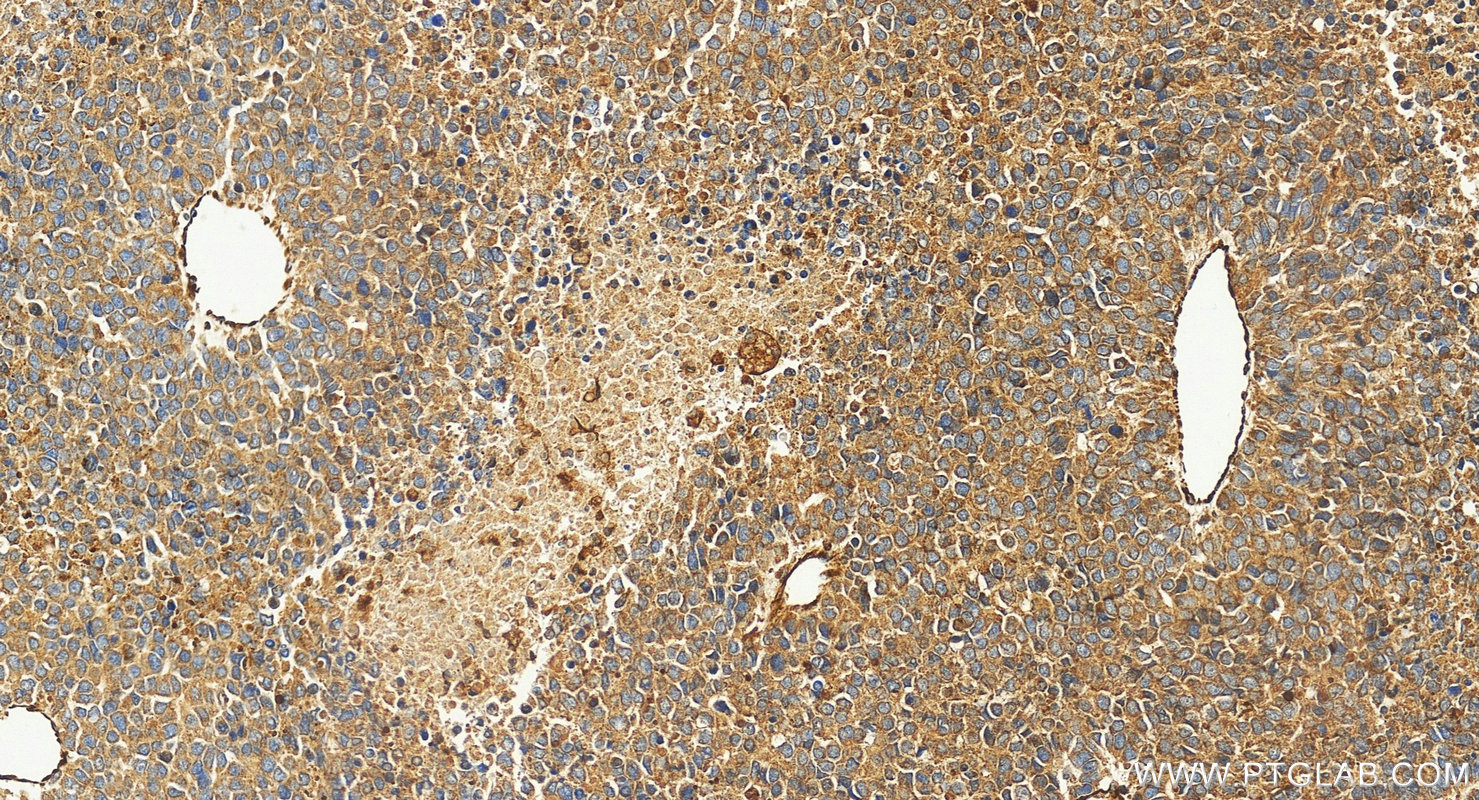 IHC staining of human Hepatocellular carcinoma using 31586-1-AP