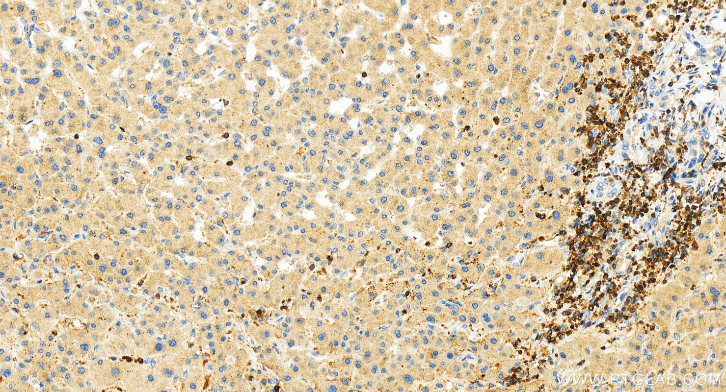 IHC staining of human intrahepatic cholangiocarcinoma using 21164-1-AP