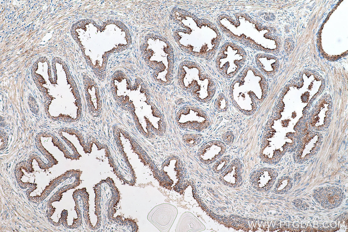 IHC staining of human prostate cancer using 67159-1-Ig